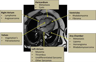Tissue characterization of benign cardiac tumors by cardiac magnetic resonance imaging, a review of core imaging protocol and benign cardiac tumors